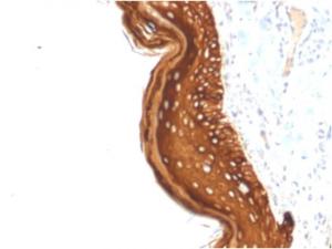 Immunohistochemical analysis of formalin-fixed, paraffin-embedded human basal cell carcinoma using Anti-Cytokeratin 15 Antibody [KRT15/2957]