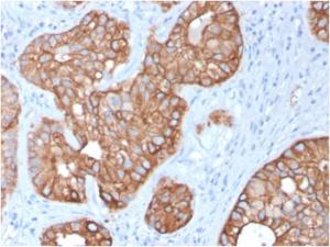 Immunohistochemical analysis of formalin-fixed, paraffin-embedded human colon carcinoma using Anti-Cytokeratin 15 Antibody [KRT15/2957]