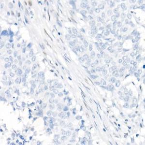 Immunohistochemistry analysis of paraffin-embedded human colon cancer loss of mlH1 expression (negative control sample) using Anti-mlH1 Antibody [ARC53543] (A308155) at a dilution of 1:200(40X lens)