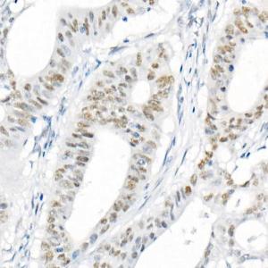 Immunohistochemistry analysis of paraffin-embedded human colon carcinoma tissue using Anti-mlH1 Antibody [ARC53543] (A308155) at a dilution of 1:200(40X lens). Perform high pressure antigen retrieval with 10 mM citrate buffer pH 6.0 before commencing with IHC staining protocol