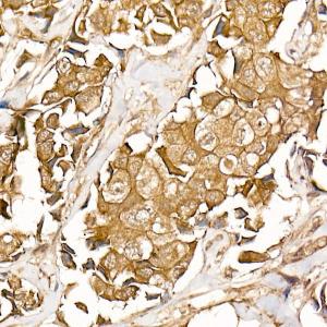 Immunohistochemistry analysis of paraffin-embedded human breast cancer tissue using Anti-beta Catenin Antibody [ARC0136] (A307069) at a dilution of 1:50(40x lens). Perform high pressure antigen retrieval with 10 mM citrate buffer pH 6.0 before commencing with IHC staining protocol.