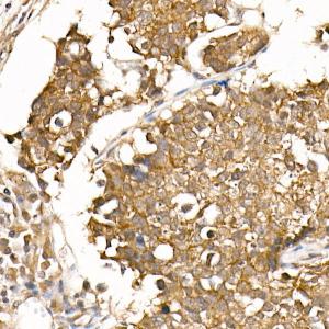 Immunohistochemistry analysis of paraffin-embedded human small cell lung cancer using Anti-beta Catenin Antibody [ARC0136] (A307069) at a dilution of 1:50(40x lens). Perform high pressure antigen retrieval with 10 mM citrate buffer pH 6.0 before commencing with IHC staining protocol.