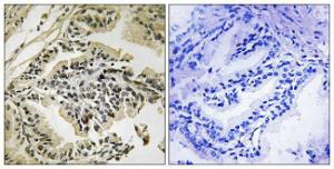 Immunohistochemical analysis of paraffin-embedded human prostate carcinoma using Anti-PERK (phospho Thr981) Antibody. The right hand panel represents a negative control, where the antibody was pre-incubated with the immunising peptide.