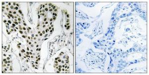 Immunohistochemical analysis of paraffin-embedded human breast carcinoma tissue using Anti-ZC3H4 Antibody The right hand panel represents a negative control, where the antibody was pre-incubated with the immunising peptide