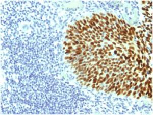 Immunohistochemical analysis of formalin-fixed, paraffin-embedded human cervical carcinoma using Anti-SOX2 Antibody [SOX2/1791]