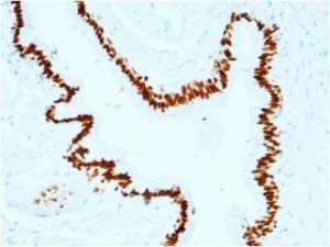 Immunohistochemical analysis of formalin-fixed, paraffin-embedded human lung carcinoma using Anti-SOX2 Antibody [SOX2/1791]