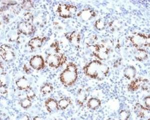 Immunohistochemical analysis of formalin-fixed, paraffin-embedded human gastric carcinoma tissue using Anti-SOX9 Antibody [SOX9/2387] at 2 µg/ml