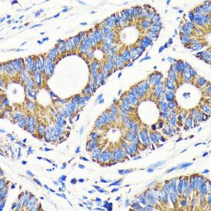 Immunohistochemistry analysis of paraffin-embedded human colon carcinoma tissue using Anti-VDAC1/Porin Antibody [ARC0187] (A307081) at a dilution of 1:100 (40X lens). Perform microwave antigen retrieval with 10 mM PBS buffer pH 7.2 before commencing with IHC staining protocol