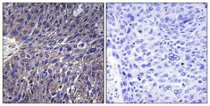 Immunohistochemical analysis of paraffin-embedded human lung carcinoma tissue using Anti-USP50 Antibody. The right hand panel represents a negative control, where the antibody was pre-incubated with the immunising peptide.