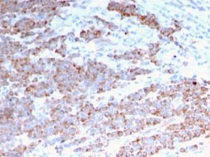 Immunohistochemical analysis of formalin-fixed, paraffin-embedded human colon carcinoma using Anti-Cytokeratin 18 Antibody [rKRT18/1190]