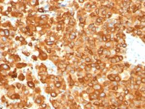 Immunohistochemical analysis of formalin-fixed, paraffin-embedded human melanoma using Anti-Melanoma gp100 Antibody [PMEL/783]