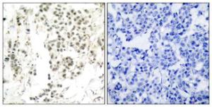 Immunohistochemical analysis of paraffin-embedded human breast carcinoma using Anti-Chk1 (phospho Ser345) Antibody. The right hand panel represents a negative control, where the antibody was pre-incubated with the immunising peptide.