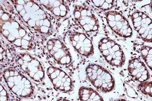 Immunohistochemistry analysis of paraffin-embedded human colon tissue using Anti-MSH2 Antibody [ARC1285] (A307085) at a dilution of 1:100 (40x lens) Perform microwave antigen retrieval with 10 mM Tris/EDTA buffer pH 90 before commencing with IHC staining protocol