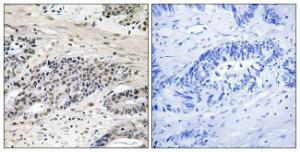 Immunohistochemical analysis of paraffin-embedded human colon carcinoma using Anti-AurA (phospho Ser342) Antibody. The right hand panel represents a negative control, where the Antibody was pre-incubated with the immunising peptide