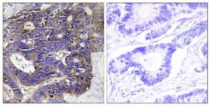 Immunohistochemical analysis of paraffin-embedded human colon carcinoma tissue using Anti-Collagen IV alpha2 Antibody. The right hand panel represents a negative control, where the Antibody was pre-incubated with the immunising peptide