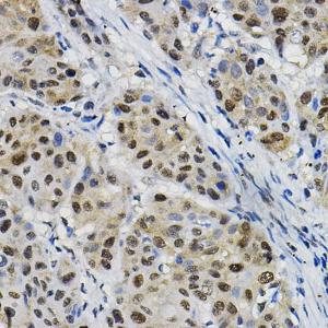 Immunohistochemistry analysis of paraffin-embedded human esophageal cancer using Anti-DNAJC17 Antibody (A307090) at a dilution of 1:20 (40X lens). Perform high pressure antigen retrieval with 10 mM citrate buffer pH 6.0 before commencing with IHC staining protocol