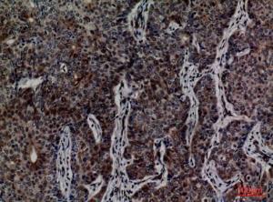 Immunohistochemical analysis of paraffin-embedded human breast cancer using Anti-MCM3 Antibody