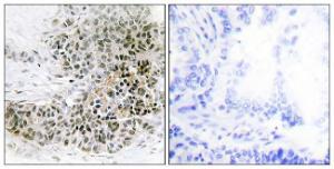 Immunohistochemical analysis of paraffin-embedded human lung carcinoma tissue using Anti-TRPS1 Antibody. The right hand panel represents a negative control, where the antibody was pre-incubated with the immunising peptide