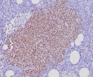 Immunohistochemical analysis of formalin-fixed, paraffin-embedded human mantle cell lymphoma tissue using Anti-SOX11 Antibody [SOX11/7236]