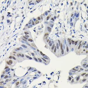 Immunohistochemistry analysis of paraffin-embedded human colon carcinoma tissue using Anti-PARP1 Antibody (A308167) at a dilution of 1:200 (40x lens). Perform high pressure antigen retrieval with 10 mM citrate buffer pH 6.0 before commencing with IHC staining protocol.