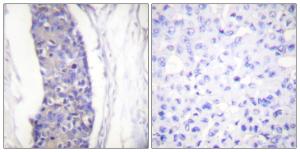 Immunohistochemical analysis of paraffin-embedded human breast carcinoma tissue using Anti-Tubulin alpha Antibody. The right hand panel represents a negative control, where the antibody was pre-incubated with the immunising peptide