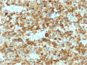 Immunohistochemical analysis of formalin-fixed, paraffin-embedded human melanoma using Anti-Melanoma gp100 Antibody [PMEL/2037]