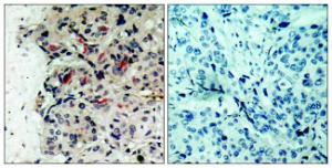 Immunohistochemical analysis of paraffin-embedded human breast carcinoma tissue using Anti-JAK1 Antibody The right hand panel represents a negative control, where the antibody was pre-incubated with the immunising peptide