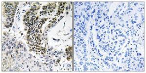 Immunohistochemical analysis of paraffin-embedded human lung carcinoma tissue using Anti-RREB1 Antibody The right hand panel represents a negative control, where the antibody was pre-incubated with the immunising peptide