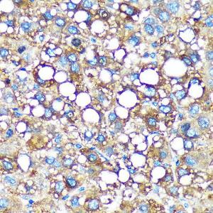 Immunohistochemistry analysis of paraffin-embedded human liver cancer using Anti-GMIP Antibody (A307109) at a dilution of 1:100 (40X lens)