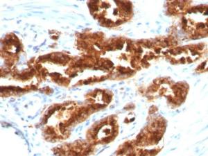 Immunohistochemical analysis of formalin-fixed, paraffin-embedded human prostate carcinoma using Anti-TAG72 Antibody [B72.3]