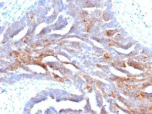 Immunohistochemical analysis of formalin-fixed, paraffin-embedded human ovarian carcinoma using Anti-TAG72 Antibody [B72.3]