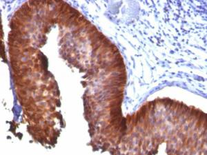 Immunohistochemical analysis of formalin-fixed, paraffin-embedded human bladder carcinoma using Anti-Cytokeratin 17 Antibody [E3]