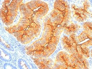 Immunohistochemical analysis of formalin-fixed, paraffin-embedded human colon carcinoma using Anti-TAG72 Antibody [B72.3]