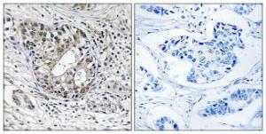 Immunohistochemical analysis of paraffin-embedded human breast carcinoma tissue using Anti-PNPT1 Antibody. The right hand panel represents a negative control, where the antibody was pre-incubated with the immunising peptide.