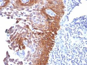 Immunohistochemical analysis of formalin-fixed, paraffin-embedded human cervical carcinoma using Anti-Cytokeratin 17 Antibody [E3]