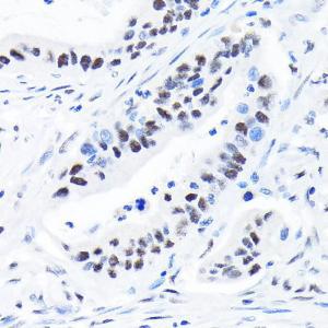 Immunohistochemistry analysis of paraffin-embedded human colon carcinoma tissue using Anti-SPT5 Antibody [ARC2380] (A308173) at a dilution of 1:100 (40X lens). Perform microwave antigen retrieval with 10 mM Tris/EDTA buffer pH 9.0 before commencing with IHC staining protocol