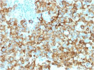 Immunohistochemical analysis of formalin-fixed, paraffin-embedded human melanoma using Anti-Melanoma gp100 Antibody [PMEL/2039]