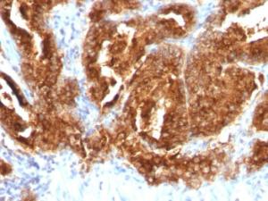 Immunohistochemical analysis of formalin-fixed, paraffin-embedded human prostate carcinoma using Anti-TAG72 Antibody [CA72/733]