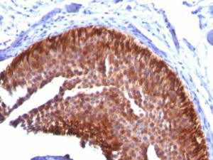 Immunohistochemical analysis of formalin-fixed, paraffin-embedded human bladder carcinoma using Anti-Cytokeratin 17 Antibody [KRT17/778]