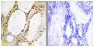 Immunohistochemical analysis of paraffin-embedded human colon carcinoma tissue using Anti-IRF2 Antibody. The right hand panel represents a negative control, where the antibody was pre-incubated with the immunising peptide.