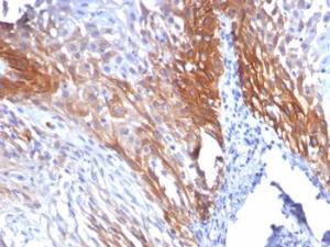 Immunohistochemical analysis of formalin-fixed, paraffin-embedded human cervical carcinoma using Anti-Cytokeratin 17 Antibody [KRT17/778]