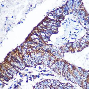 Immunohistochemistry analysis of paraffin-embedded human colon carcinoma tissue using Anti-DOK4 Antibody (A12554) at a dilution of 1:100 (40X lens). Perform microwave antigen retrieval with 10 mM PBS buffer pH 7.2 before commencing with IHC staining protocol