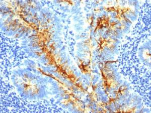 Immunohistochemical analysis of formalin-fixed, paraffin-embedded human colon carcinoma using Anti-TAG72 Antibody [CA72/733]