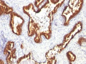 Immunohistochemical analysis of formalin-fixed, paraffin-embedded human prostate carcinoma using Anti-Cytokeratin 18 Antibody [KRT18/1190]