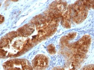 Immunohistochemical analysis of formalin-fixed, paraffin-embedded human prostate carcinoma using Anti-TAG72 Antibody [B72.3 + CC49]