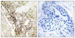 Immunohistochemical analysis of paraffin-embedded human breast carcinoma tissue using Anti-MED21 Antibody The right hand panel represents a negative control, where the antibody was pre-incubated with the immunising peptide