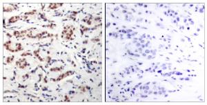 Immunohistochemical analysis of paraffin-embedded human breast carcinoma using Anti-STAT5A (phospho Tyr694) Antibody. The right hand panel represents a negative control, where the antibody was pre-incubated with the immunising peptide