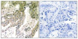 Immunohistochemical analysis of paraffin-embedded human lung carcinoma tissue using Anti-LAMA5 Antibody. The right hand panel represents a negative control, where the Antibody was pre-incubated with the immunising peptide