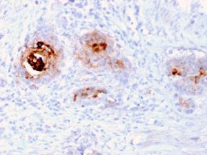 Immunohistochemical analysis of formalin-fixed, paraffin-embedded human breast carcinoma using Anti-TAG72 Antibody [rB72.3]