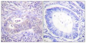 Immunohistochemical analysis of paraffin-embedded human colon carcinoma using Anti-PFKFB2 (phospho Ser483) Antibody. The right hand panel represents a negative control, where the antibody was pre-incubated with the immunising peptide